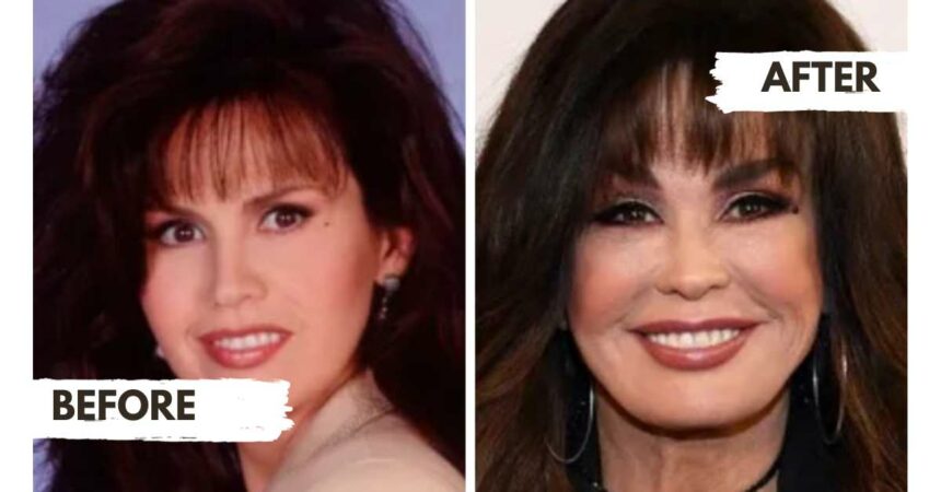 Marie Osmond Plastic Surgery The Journey Of A Beautiful Transformation