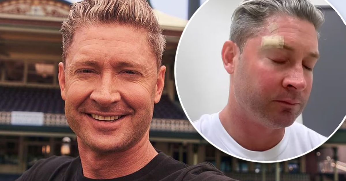 Michael Clarke plastic surgery