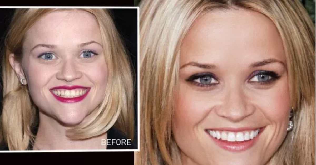 Reese Witherspoon’s Smile Makeover