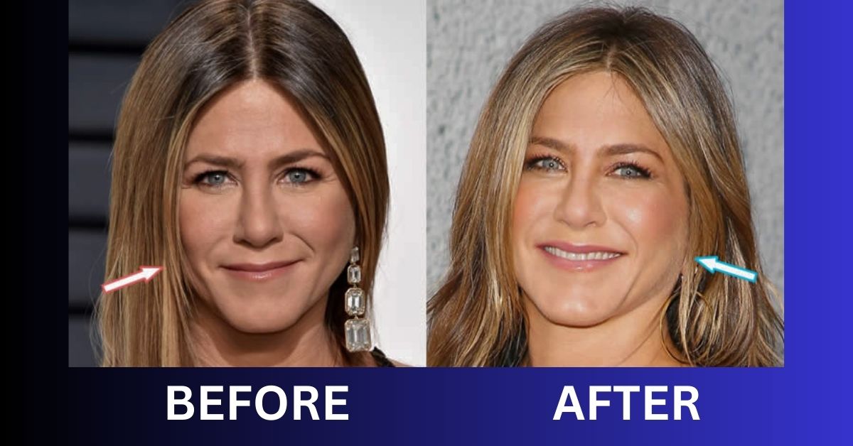 Jennifer Aniston Plastic Surgery