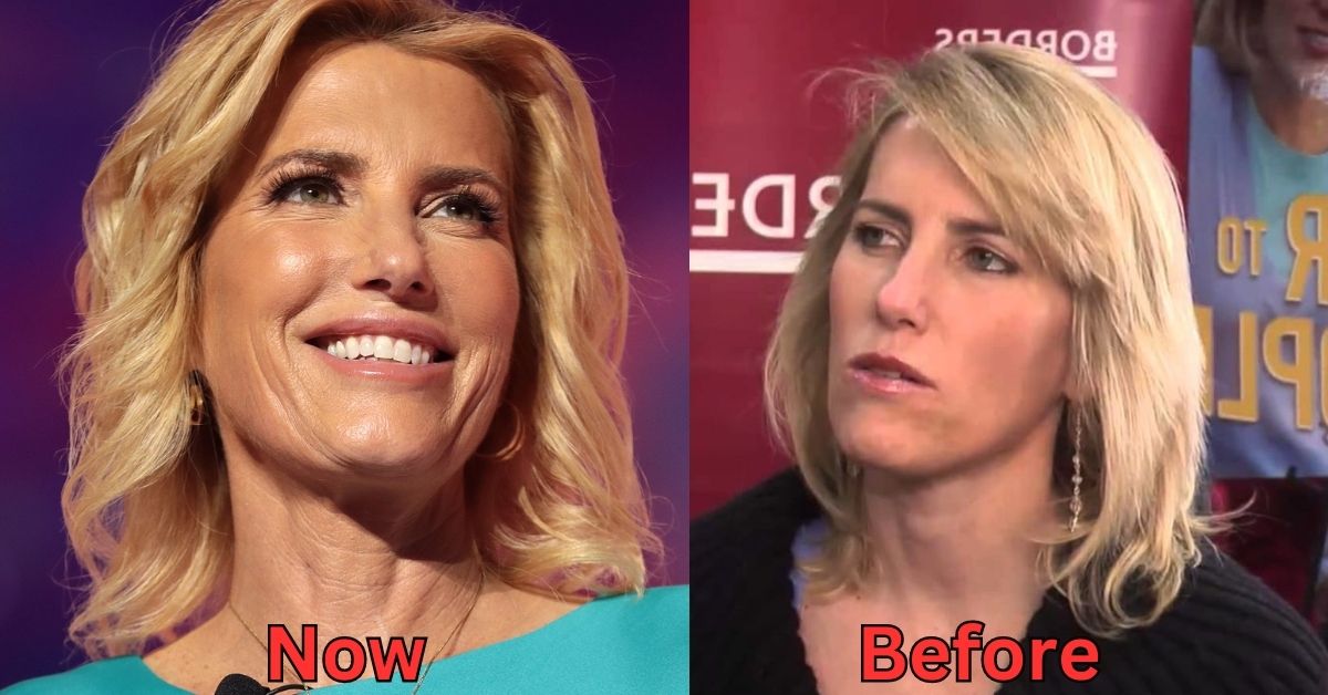 Laura Ingraham plastic surgery