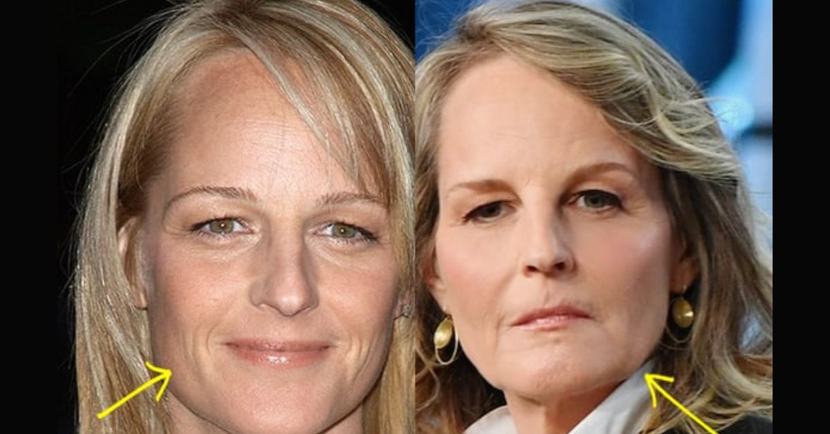 did helen hunt have plastic surgery 