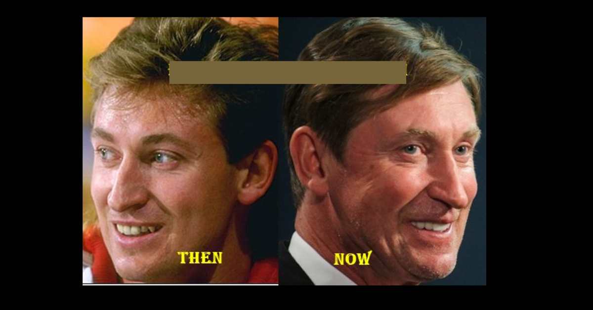 Wayne Gretzky Plastic Surgery: Assessing the Possible Facelift and Botox Procedures Botox
