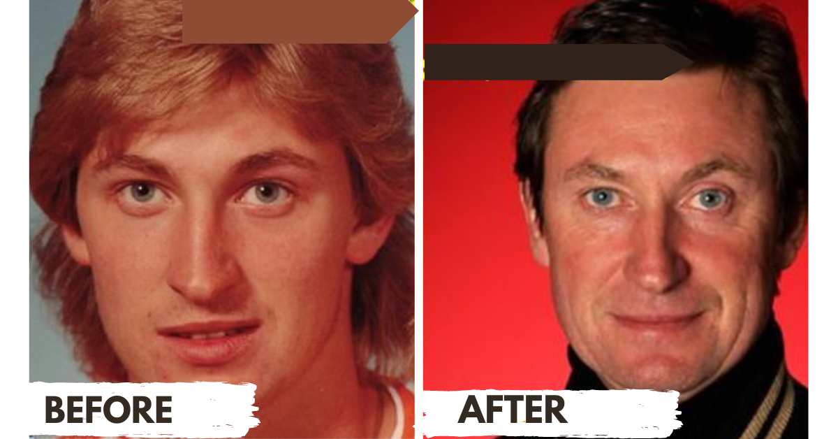 Wayne Gretzky Plastic Surgery: Assessing the Possible Facelift and Botox Procedures Facelift