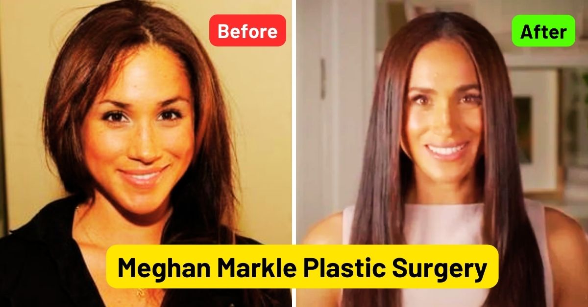 Meghan Markle Plastic Surgery