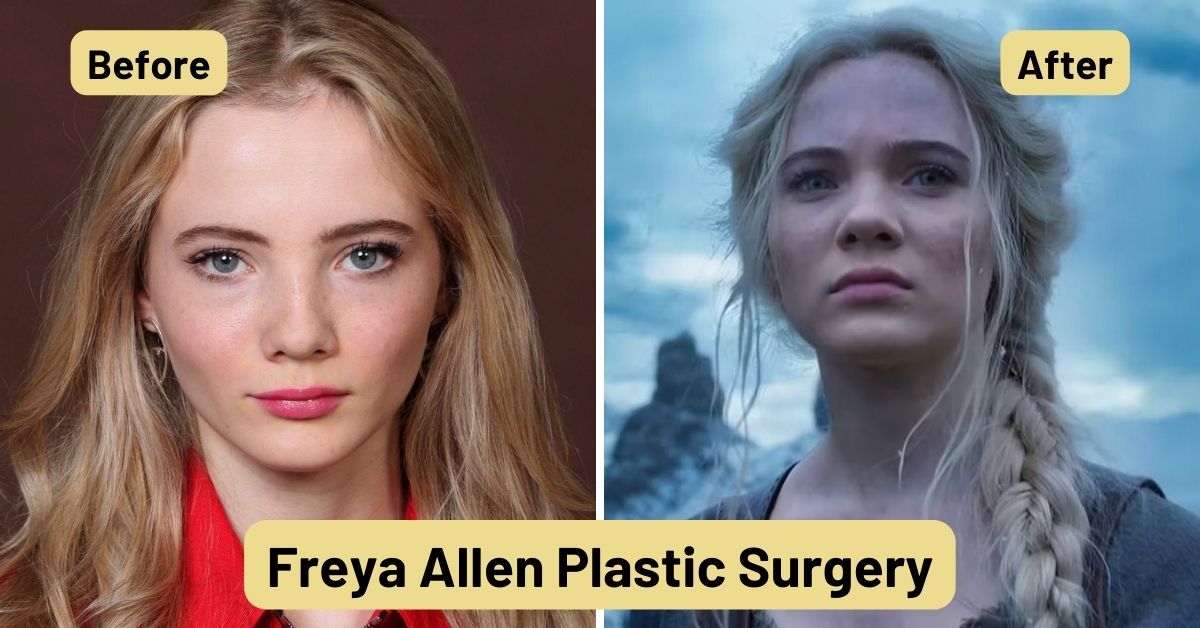 Freya Allen Plastic Surgery