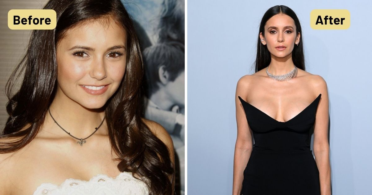 Nina Dobrev Plastic Surgery