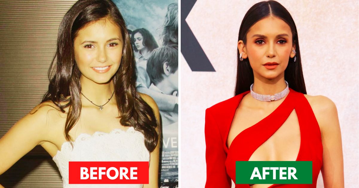 Nina Dobrev Plastic Surgery