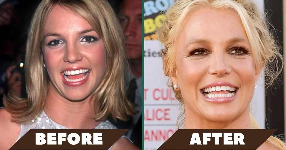 What Happened to Britney Spears Teeth