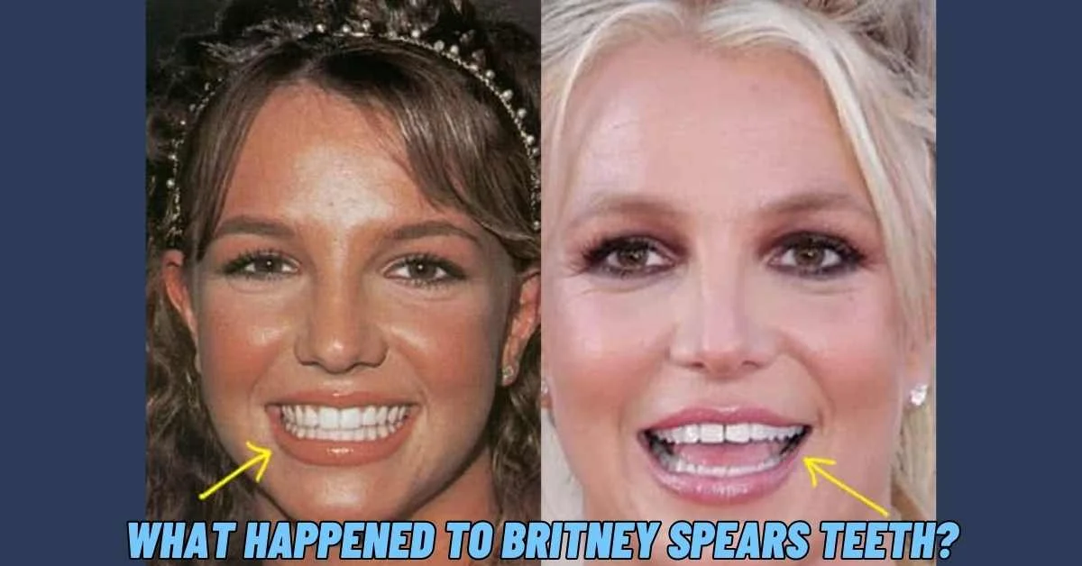 What Happened to Britney Spears Teeth