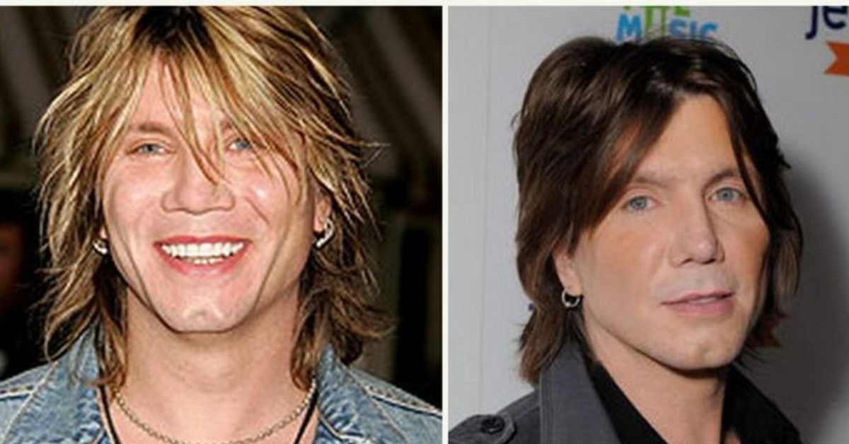 john rzeznik plastic surgery