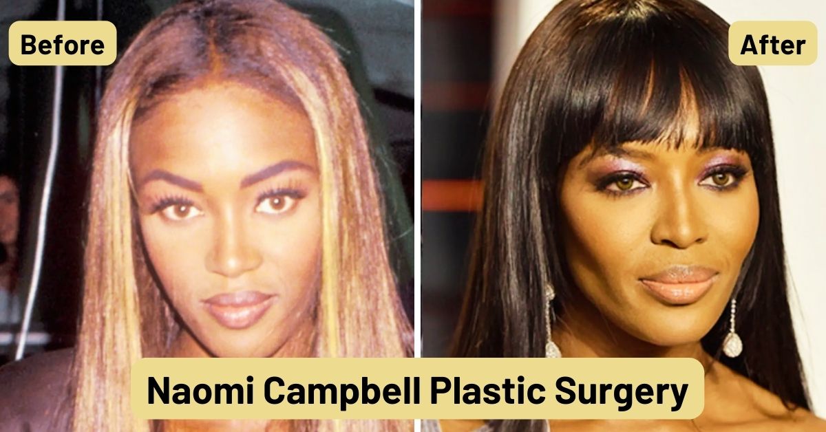 Naomi Campbell Plastic Surgery