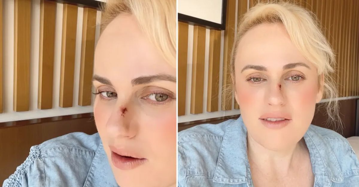 Rebel Wilson Injury