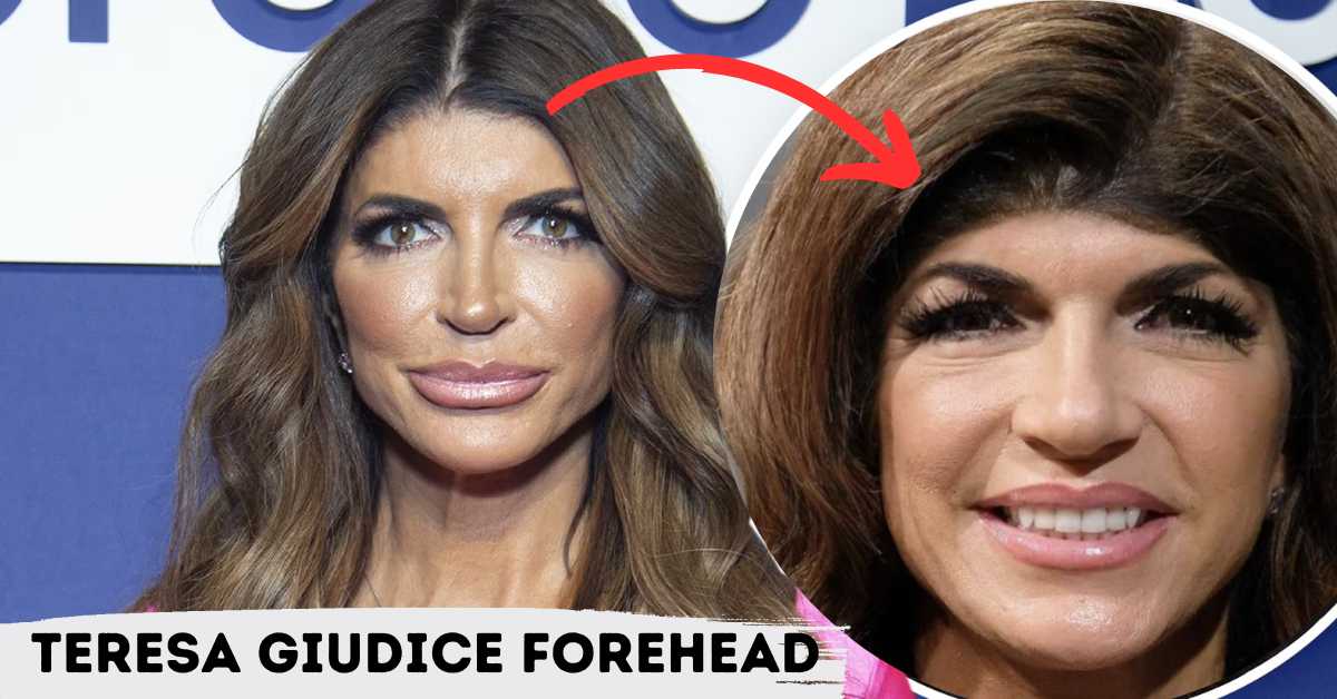 teresa giudice forehead