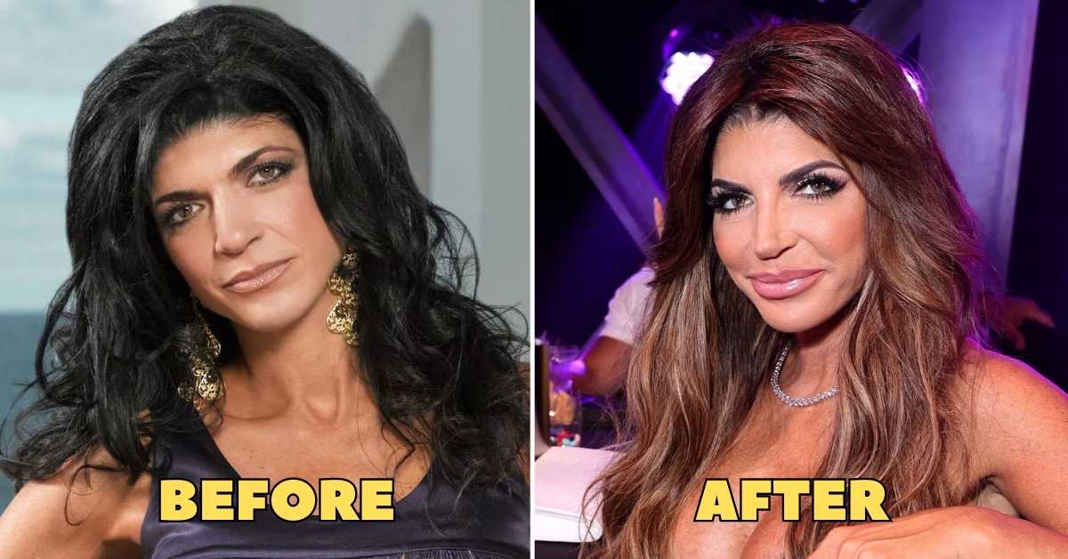 teresa giudice forehead