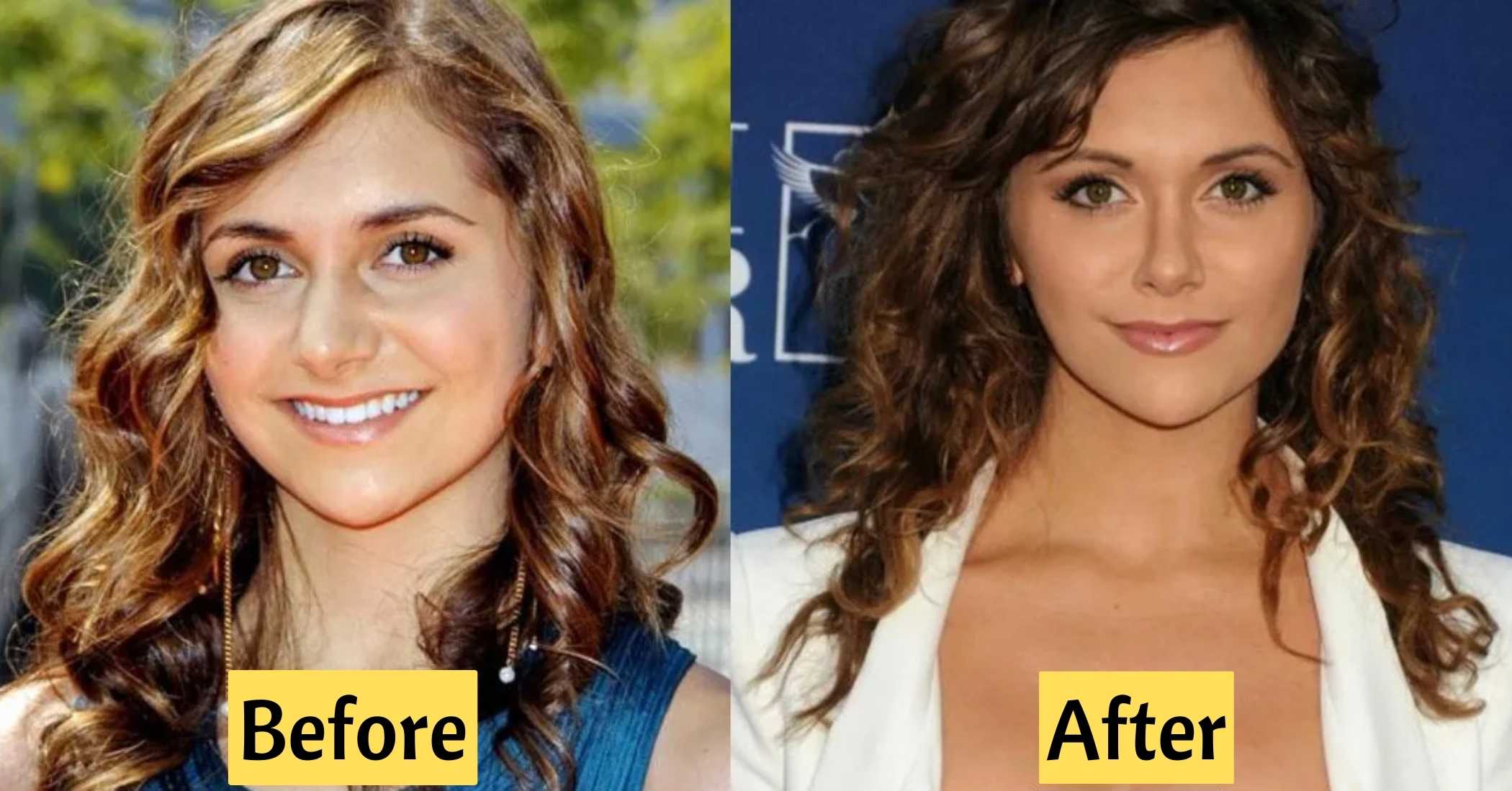 alyson stoner plastic surgery