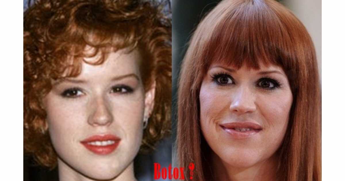 molly ringwald plastic surgery 