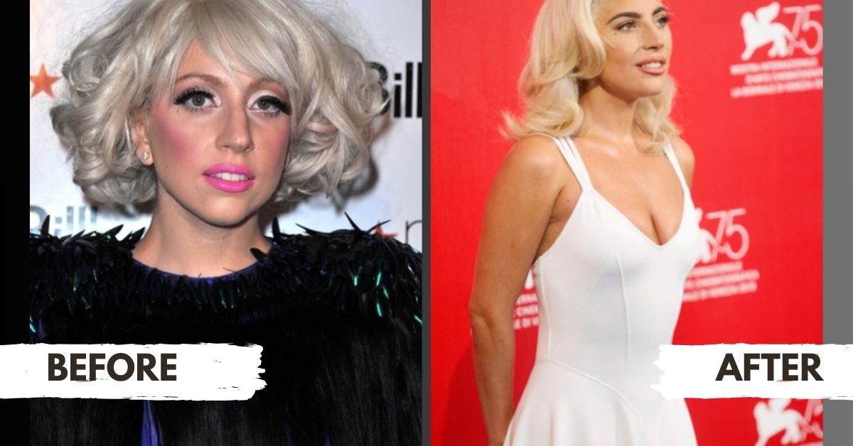 Lady Gaga Plastic Surgery Before And After Photos