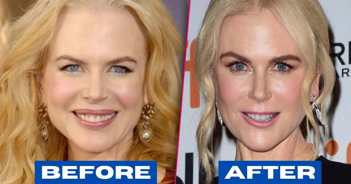 Nicole Kidman Plastic Surgery before and after