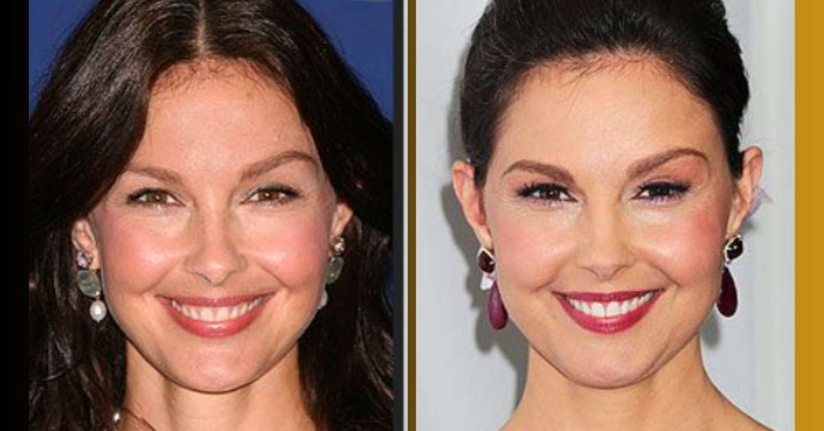 What Plastic Surgery Has Ashley Judd had