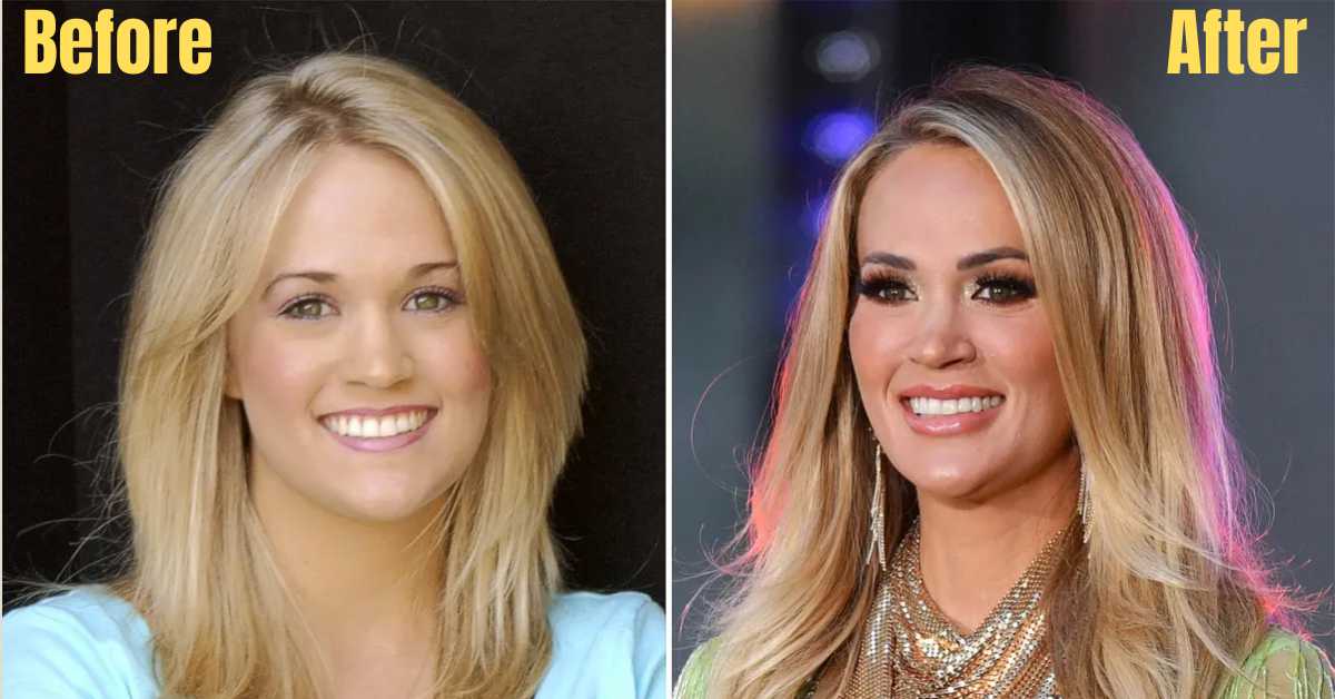 carrie underwood plastic surgery 