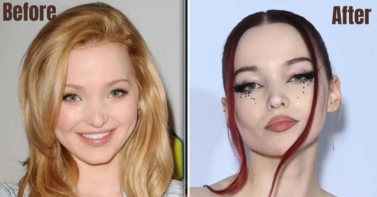 dove cameron plastic surgery 