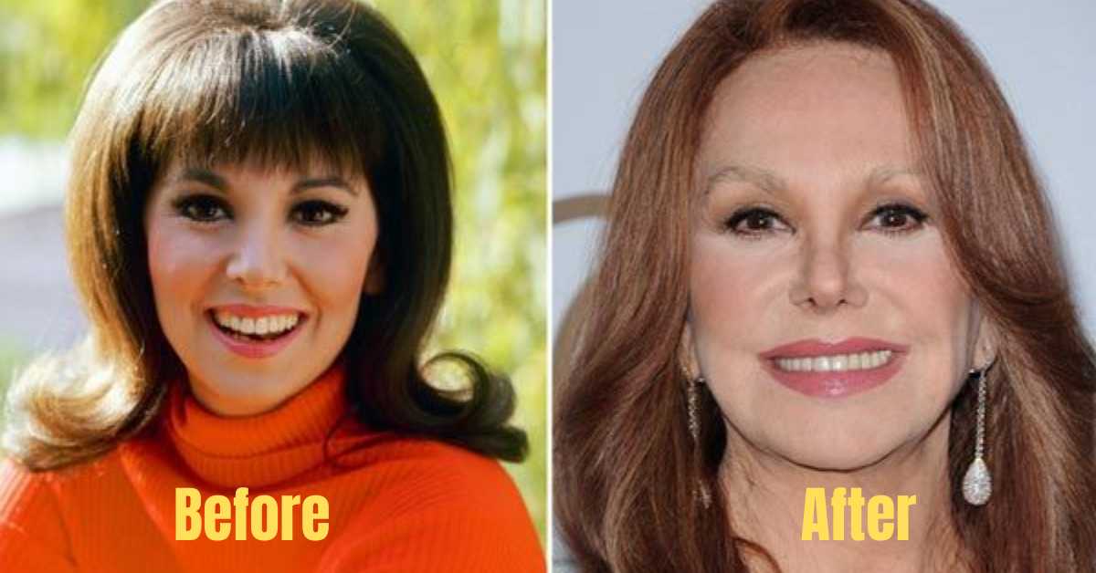 marlo thomas plastic surgery (1)