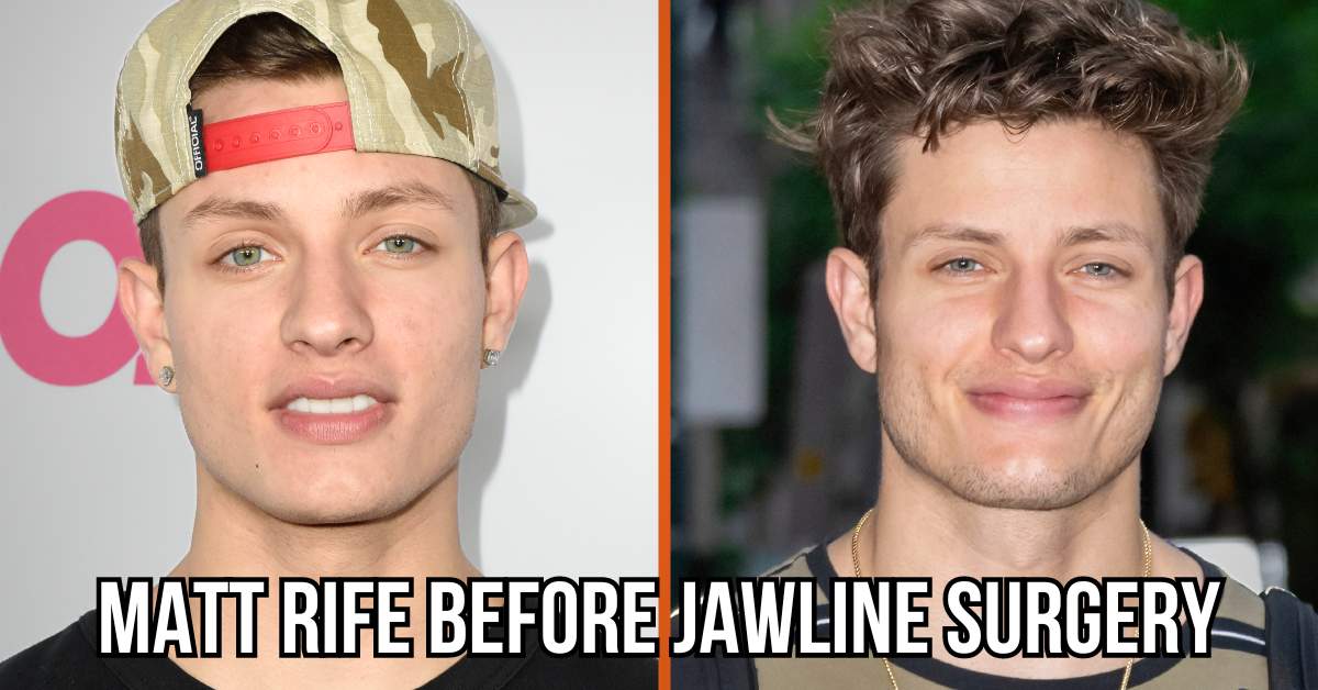 matt rife before jawline surgery