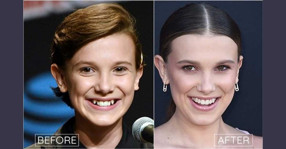 millie bobby brown plastic surgery