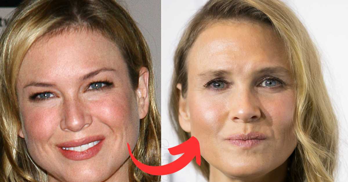 renee zellweger plastic surgery