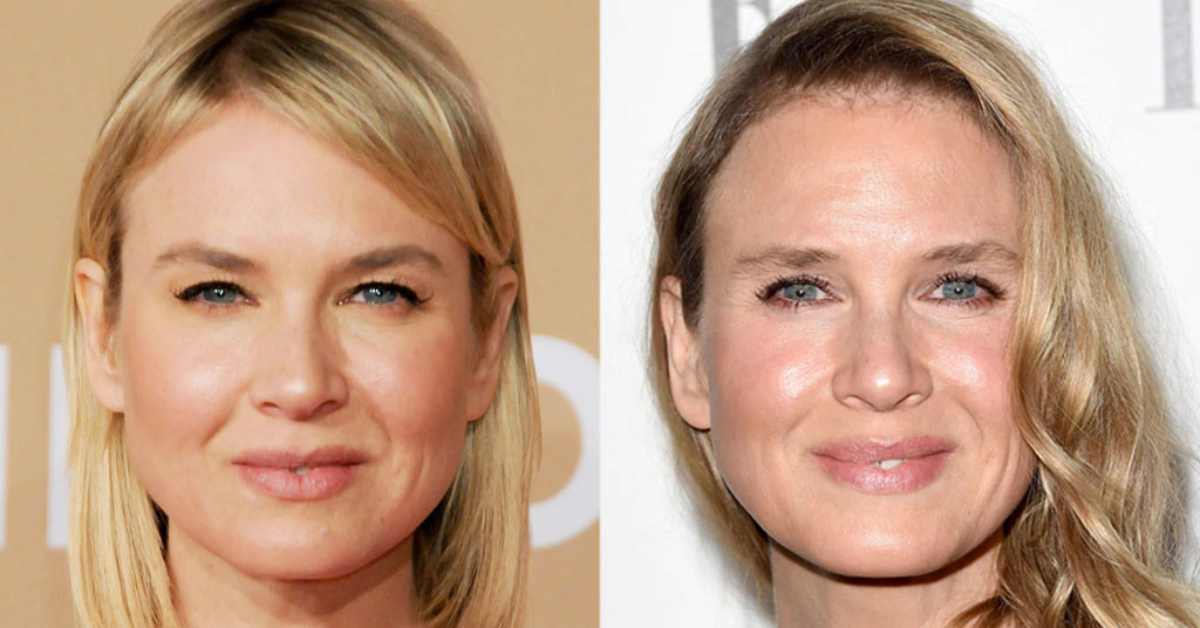 renee zellweger plastic surgery