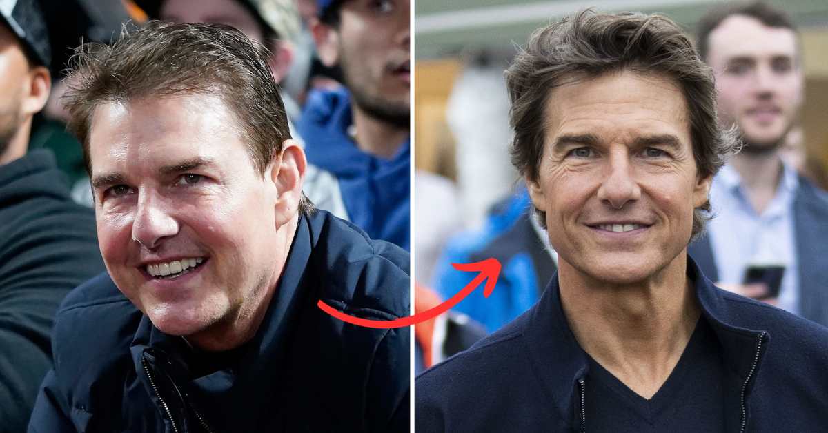 tom cruise plastic surgery