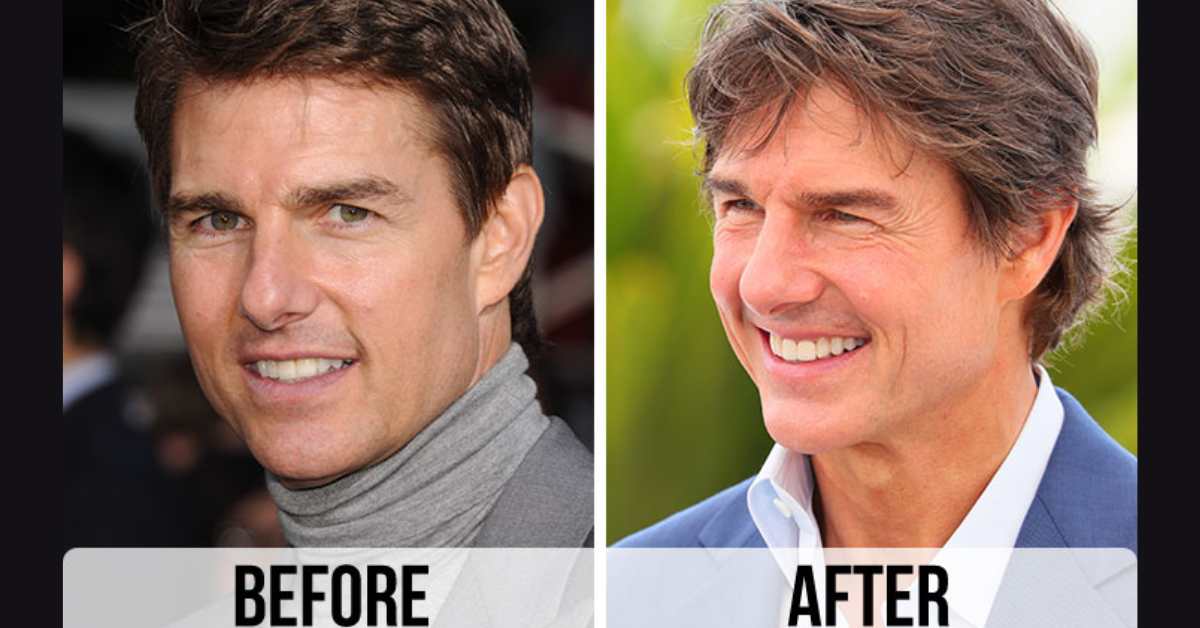 tom cruise plastic surgery 