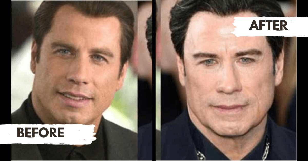 John Travolta Plastic Surgery Before and After