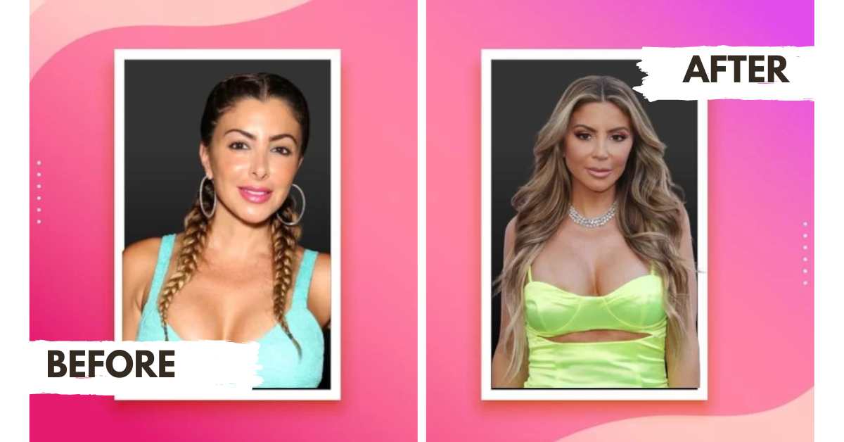 Larsa Pippen Before and AfterSurgery