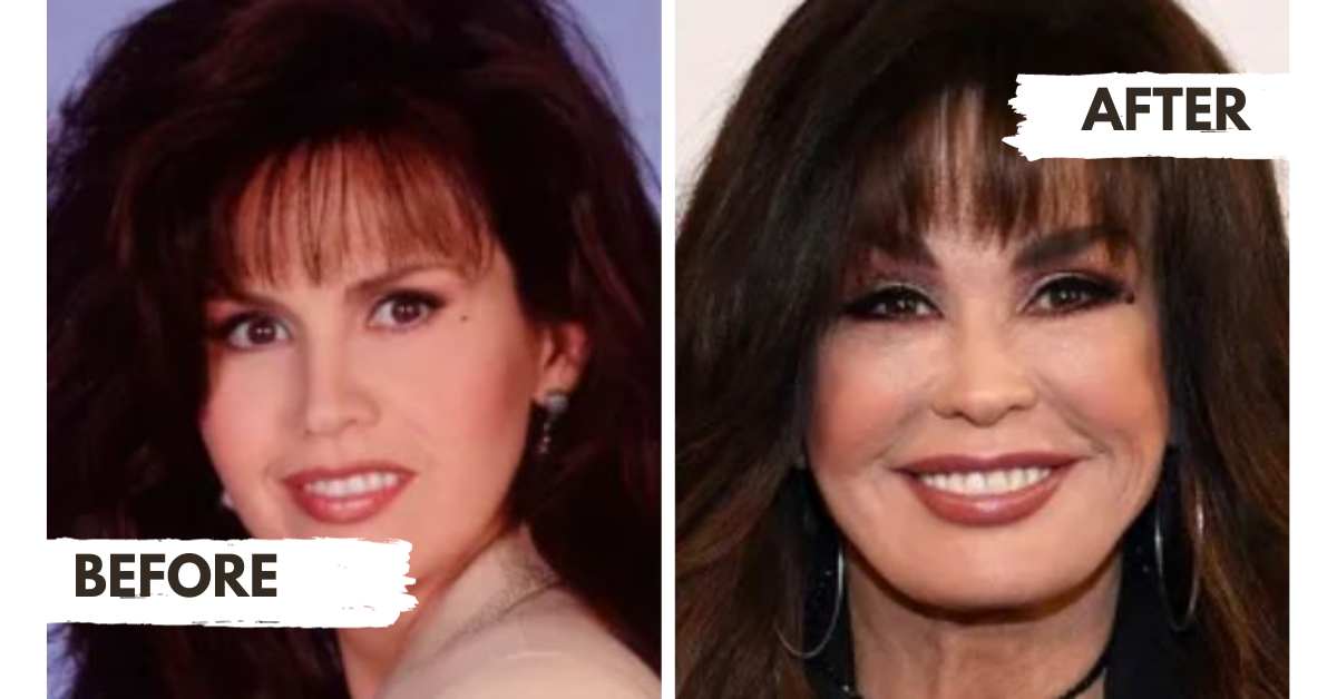 Marie Osmond Plastic Surgery Before and After