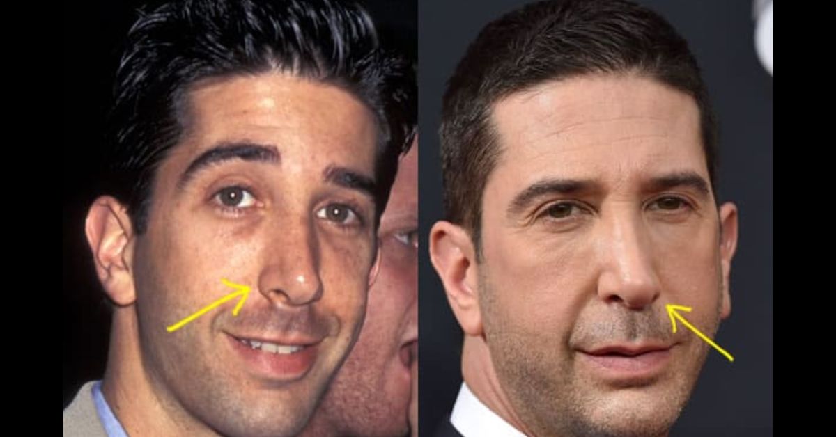 david schwimmer plastic surgery