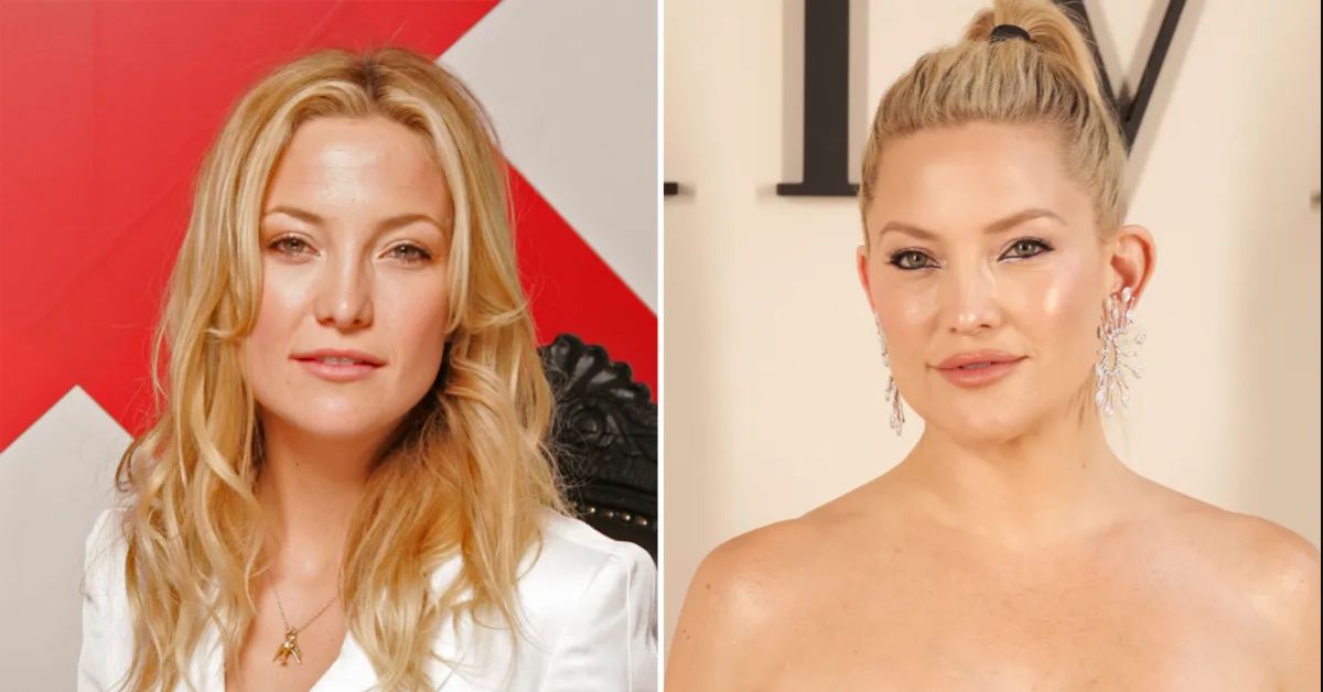 kate hudson plastic surgery (1)