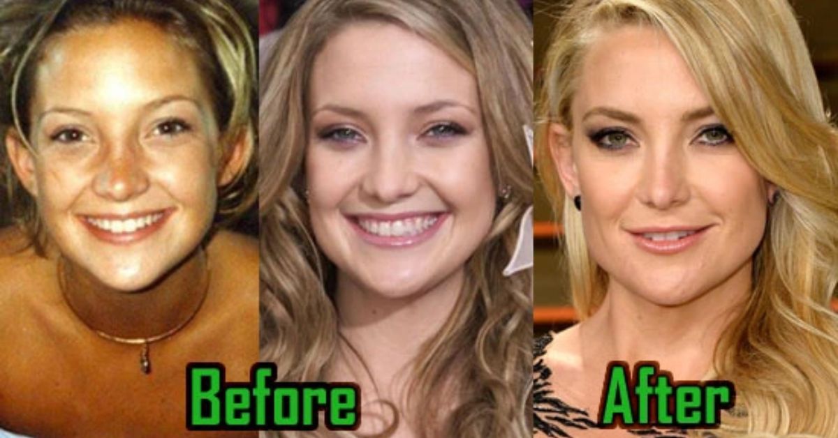 kate hudson plastic surgery