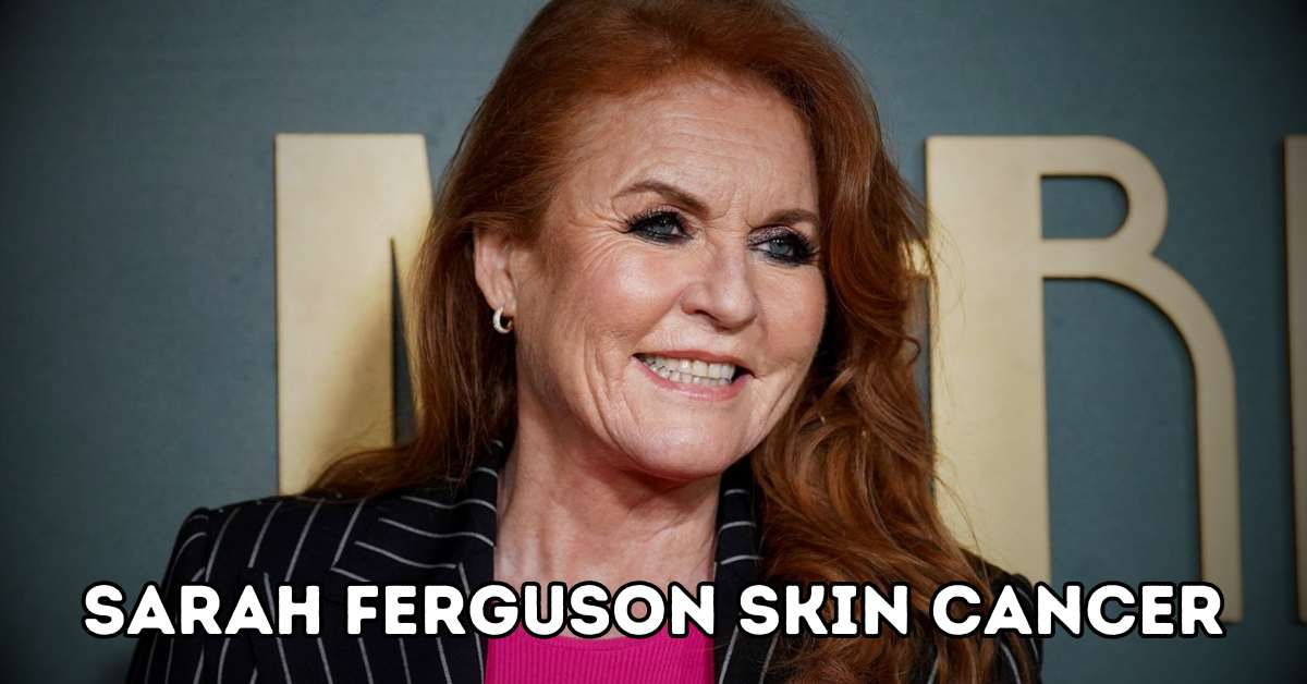 sarah ferguson skin cancer