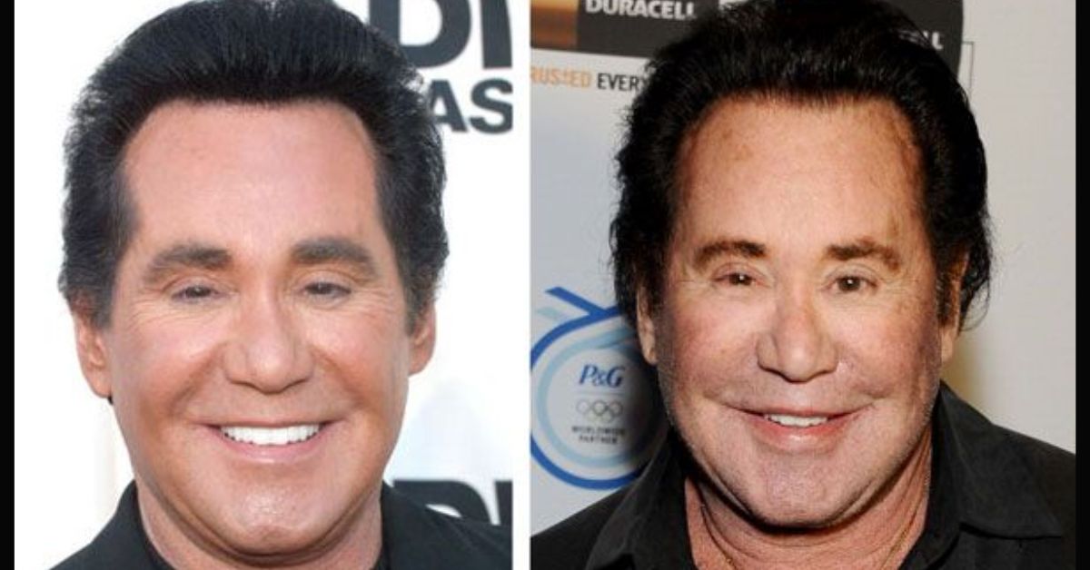 wayne newton plastic surgery